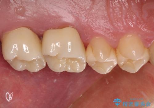 抜歯と言われた奥歯 根管治療と補綴治療の治療後