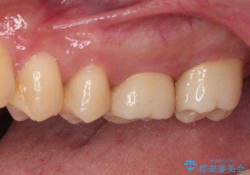 抜歯と言われた奥歯　根管治療と補綴治療の治療後