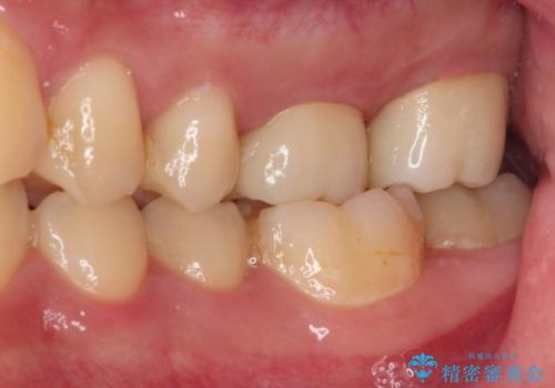 抜歯と言われた奥歯 根管治療と補綴治療の治療後