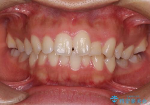 【モニター】閉じにくい口元 ワイヤー装置での抜歯矯正の症例 治療前