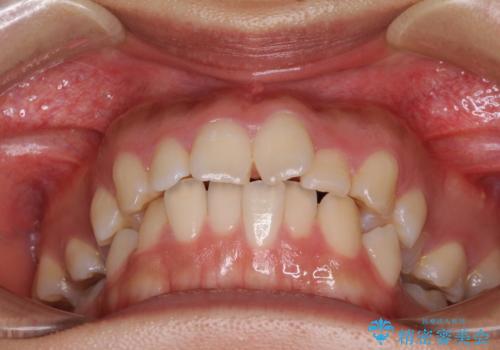 【モニター】閉じにくい口元 ワイヤー装置での抜歯矯正の治療前