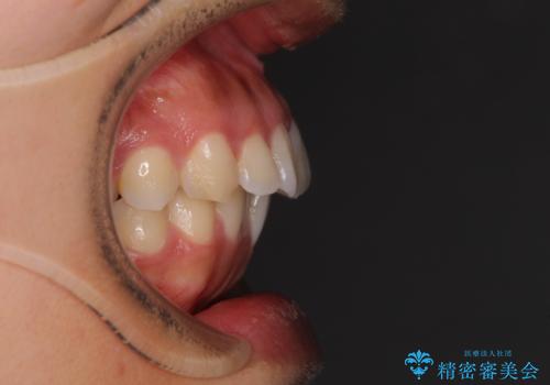 【モニター】閉じにくい口元 ワイヤー装置での抜歯矯正の治療前