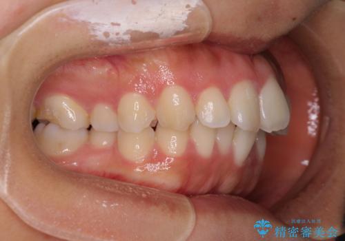 【モニター】閉じにくい口元 ワイヤー装置での抜歯矯正の治療前