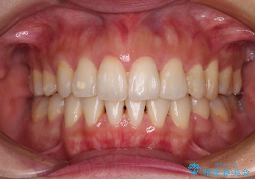 裏側矯正の途中で海外へ インビザライン・チェンジによる矯正治療の症例 治療後