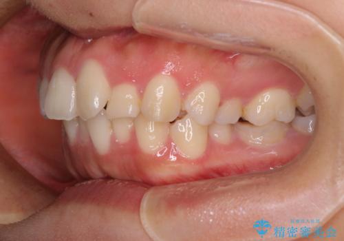 【モニター】閉じにくい口元 ワイヤー装置での抜歯矯正の治療前