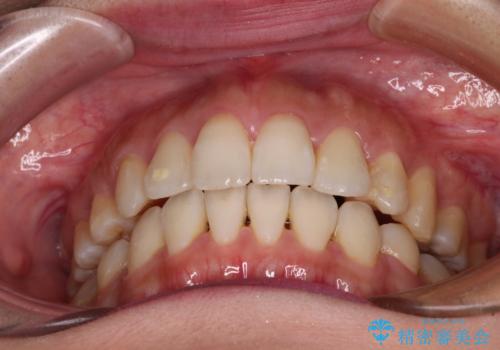 裏側矯正の途中で海外へ インビザライン・チェンジによる矯正治療の治療後