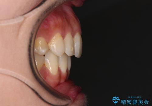 裏側矯正の途中で海外へ インビザライン・チェンジによる矯正治療の治療後