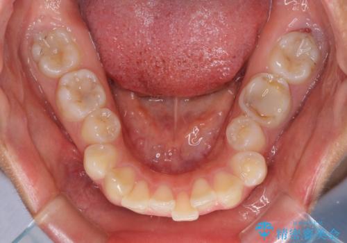 【モニター】閉じにくい口元 ワイヤー装置での抜歯矯正の治療前