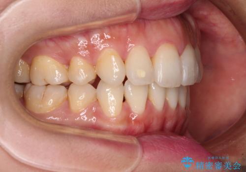 裏側矯正の途中で海外へ インビザライン・チェンジによる矯正治療の治療後