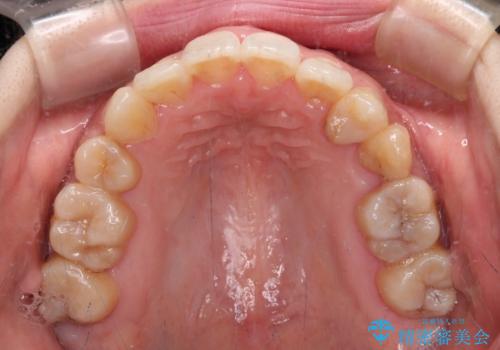 裏側矯正の途中で海外へ インビザライン・チェンジによる矯正治療の治療後