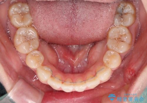 裏側矯正の途中で海外へ インビザライン・チェンジによる矯正治療の治療後