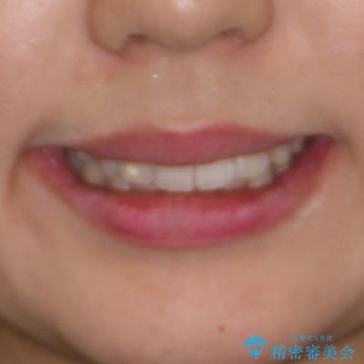裏側矯正の途中で海外へ インビザライン・チェンジによる矯正治療の治療後(顔貌)