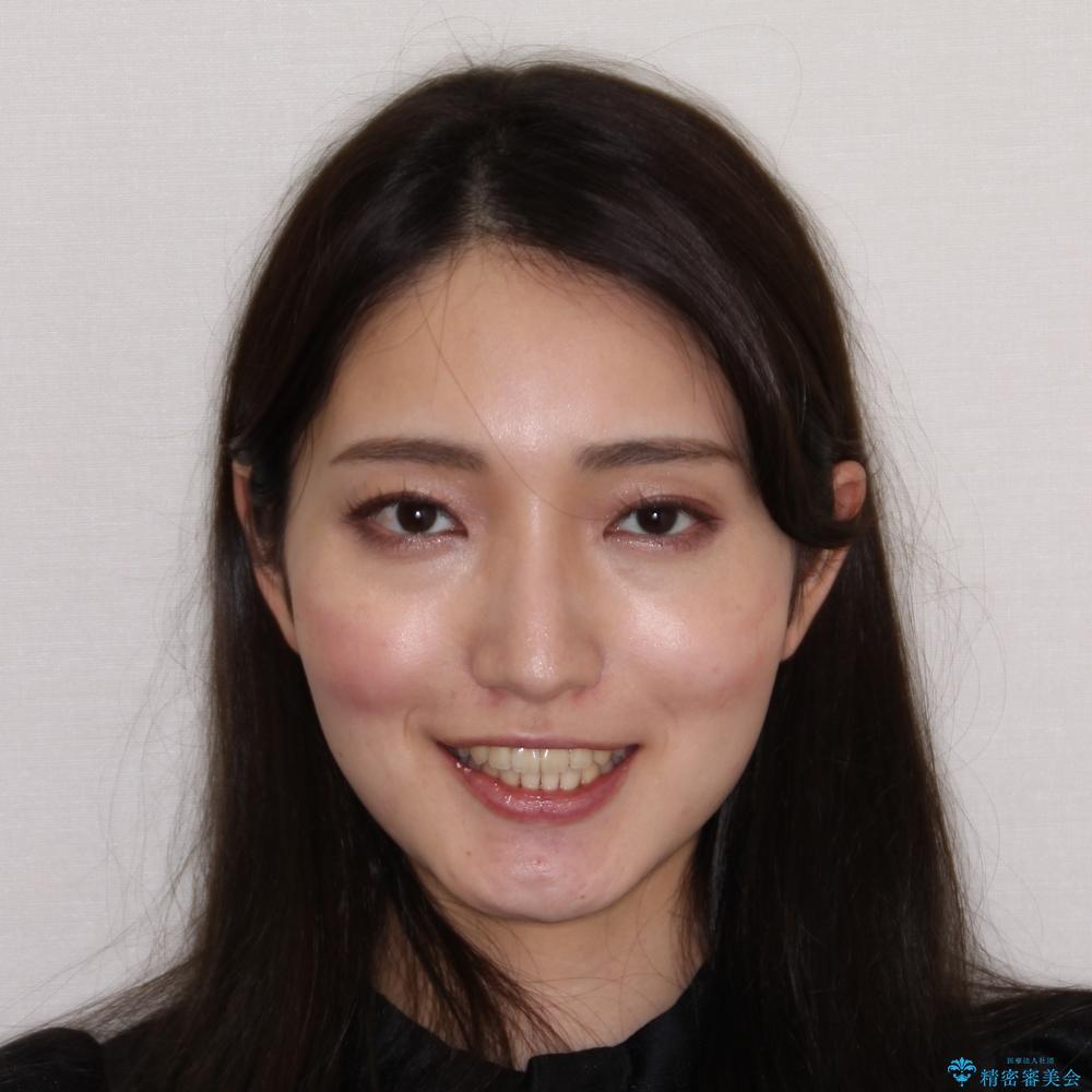 【モニター】捻れた前歯をスッキリと インビザライン矯正治療の治療後(顔貌)