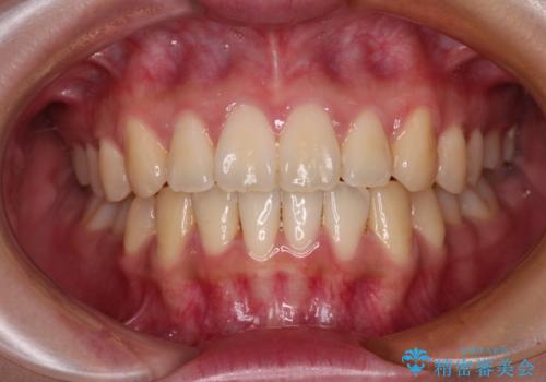 【モニター】捻れた前歯をスッキリと インビザライン矯正治療の治療後