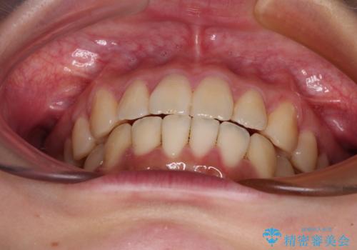 【モニター】捻れた前歯をスッキリと インビザライン矯正治療の治療後