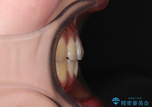 【モニター】捻れた前歯をスッキリと インビザライン矯正治療の治療後