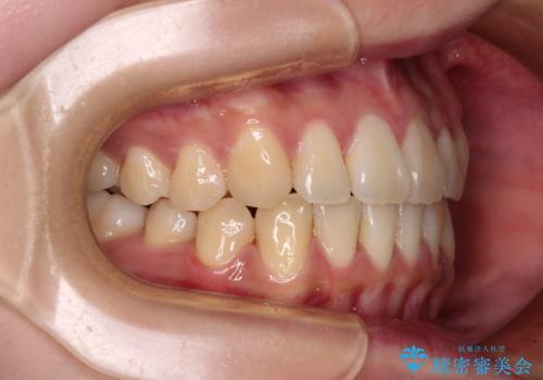 【モニター】捻れた前歯をスッキリと インビザライン矯正治療の治療後