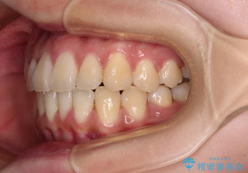 【モニター】捻れた前歯をスッキリと インビザライン矯正治療の治療後