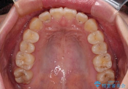 【モニター】捻れた前歯をスッキリと インビザライン矯正治療の治療後