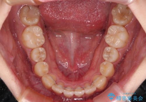 【モニター】捻れた前歯をスッキリと インビザライン矯正治療の治療後