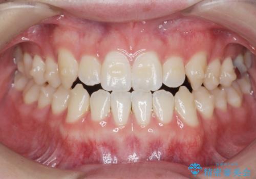 前歯で物を噛みきれない　マウスピース矯正で改善の治療中