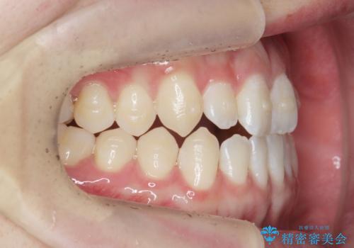 前歯で物を噛みきれない マウスピース矯正で改善の治療中