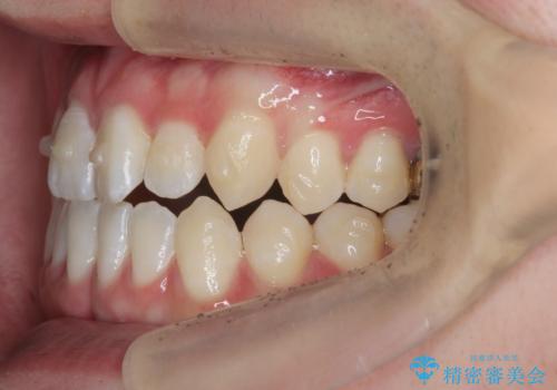 前歯で物を噛みきれない マウスピース矯正で改善の治療中