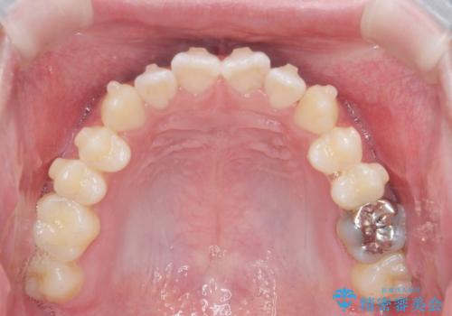 前歯で物を噛みきれない マウスピース矯正で改善の治療中