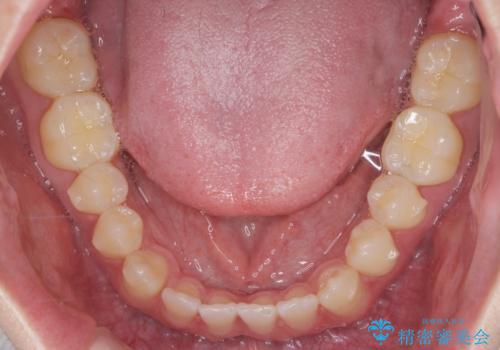 前歯で物を噛みきれない　マウスピース矯正で改善の治療中