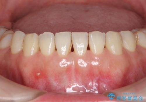 他院で矯正後、歯の神経が死んでしまった歯の治療 の治療前