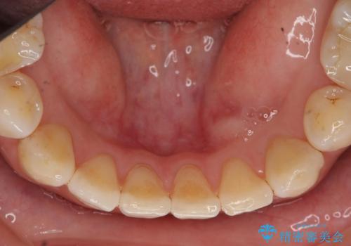 他院で矯正後、歯の神経が死んでしまった歯の治療 の治療前