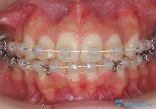 口元大事です! 見違える矯正!! 乱ぐい歯もあきらめないでください。の治療中