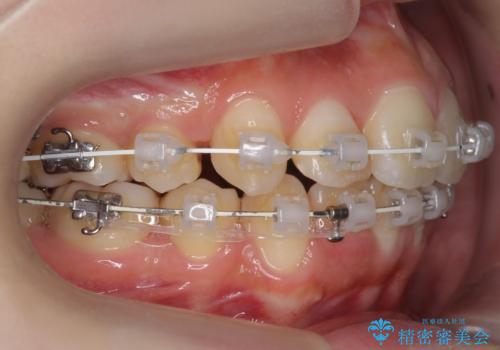 口元大事です! 見違える矯正!! 乱ぐい歯もあきらめないでください。の治療中