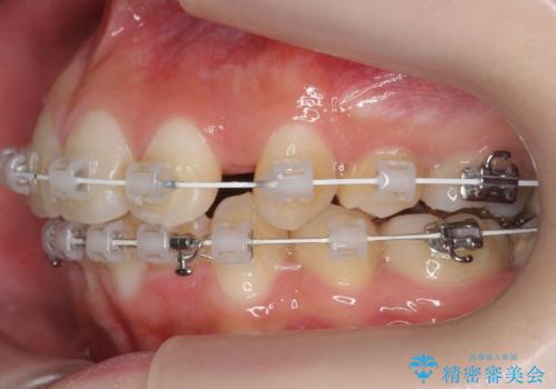 口元大事です! 見違える矯正!! 乱ぐい歯もあきらめないでください。の治療中