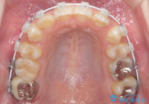 口元大事です! 見違える矯正!! 乱ぐい歯もあきらめないでください。の治療中
