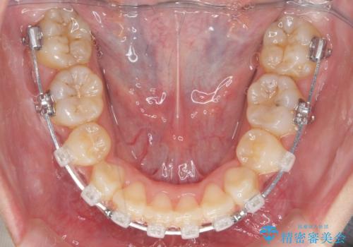 口元大事です! 見違える矯正!! 乱ぐい歯もあきらめないでください。の治療中