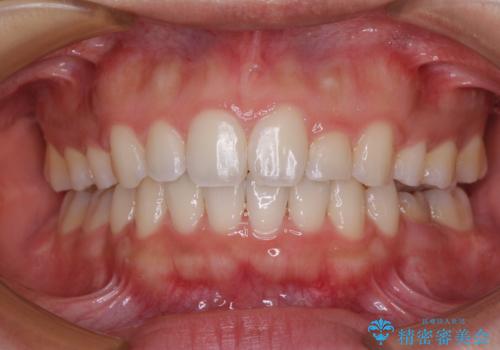 【モニター】閉じにくい口元 ワイヤー装置での抜歯矯正の症例 治療後