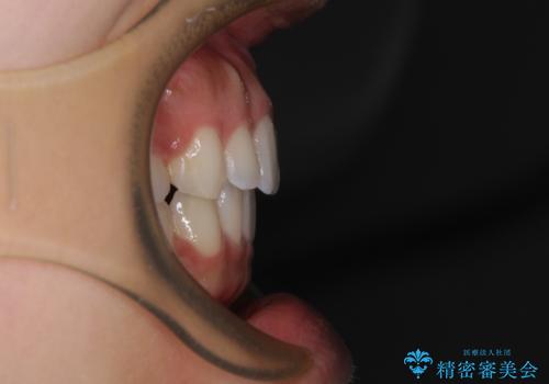 【モニター】閉じにくい口元 ワイヤー装置での抜歯矯正の治療後