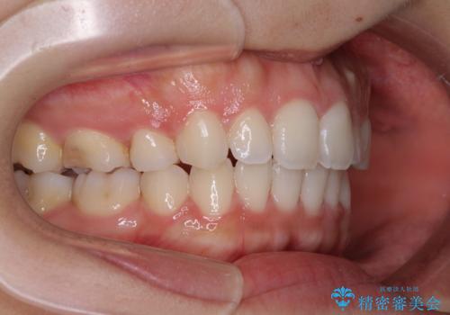 【モニター】閉じにくい口元 ワイヤー装置での抜歯矯正の治療後