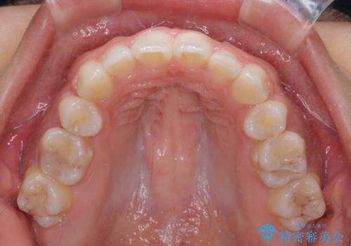 【モニター】閉じにくい口元 ワイヤー装置での抜歯矯正の治療後