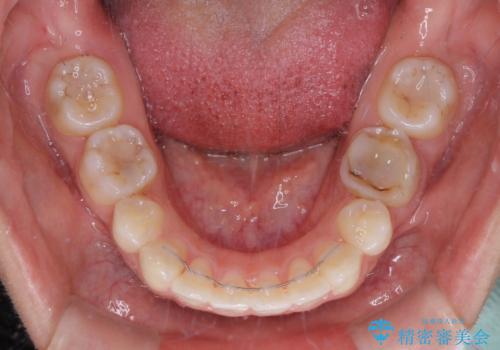 【モニター】閉じにくい口元 ワイヤー装置での抜歯矯正の治療後
