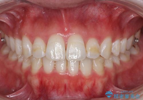 下の歯のがたつき 上より気になるの治療中