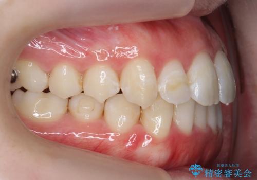 下の歯のがたつき 上より気になるの治療中