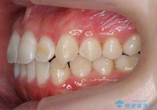 下の歯のがたつき 上より気になるの治療中