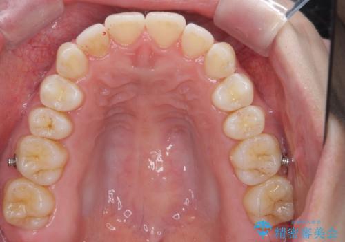 下の歯のがたつき 上より気になるの治療中