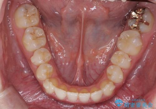 下の歯のがたつき 上より気になるの治療中