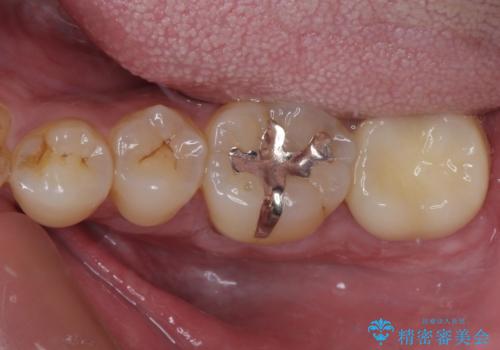治療途中で転院 奥歯のセラミック補綴治療の治療後