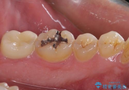 治療途中で転院 奥歯のセラミック補綴治療の治療後