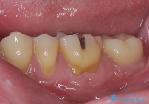 治療途中で転院 奥歯のセラミック補綴治療の治療後