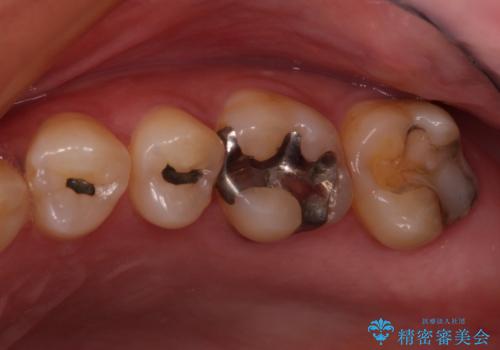 何度も外れてしまう銀歯　ゴールドインレーによる虫歯治療の治療前